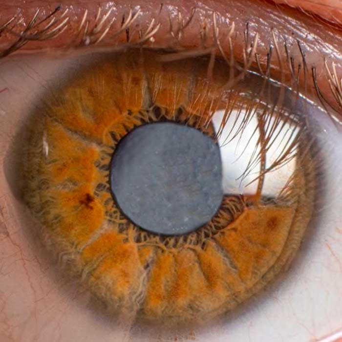 examen del fondo de ojo